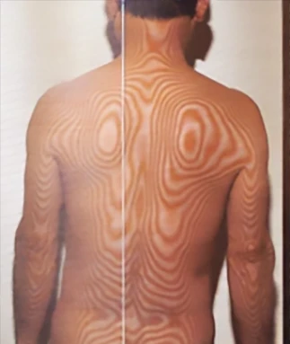 梅尼埃病|检查对自主神经造成负担的身体歪斜